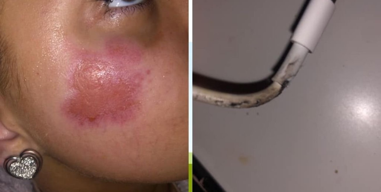 Un cargador estalla y quema la cara de una joven mientras dormía en su cama