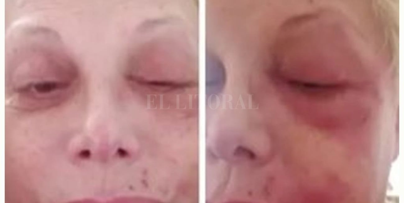 Carmen Barbieri contó que le salió culebrilla por el estrés