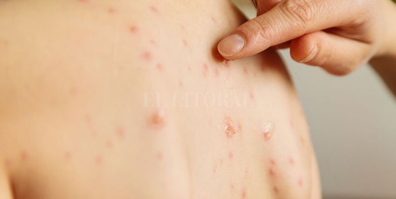 Fernández, sobre casos sarampión: "El ajuste llegó a la inmoralidad de no garantizar vacunación"