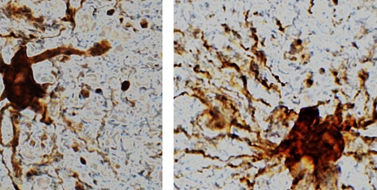 Descubren "células zombis" en el cerebro que continúan creciendo después de la muerte