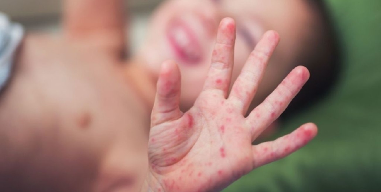 Argentina dio por terminado el brote de sarampión y lo informó a la OMS