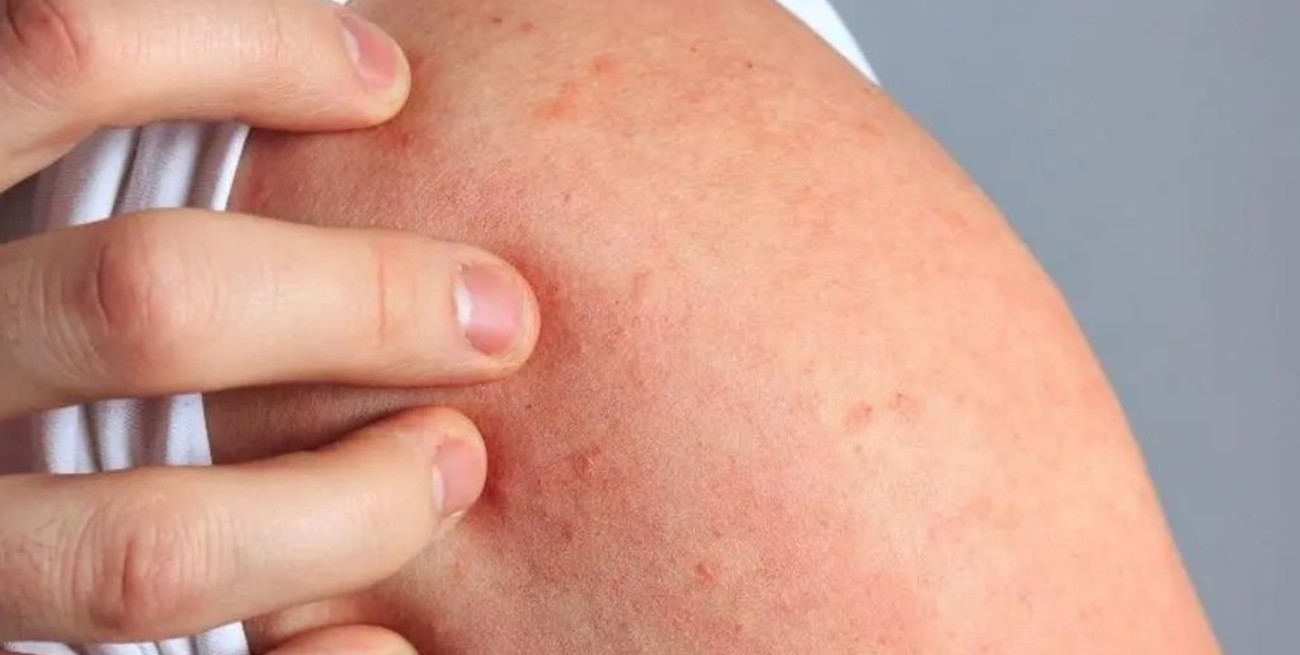 Día Mundial de la Dermatitis Atópica: todo lo que hay que saber