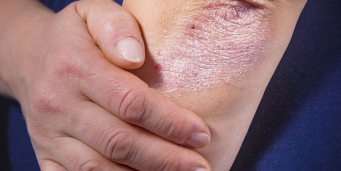 Campaña de detección gratuita de enfermedad psoriásica en Argentina