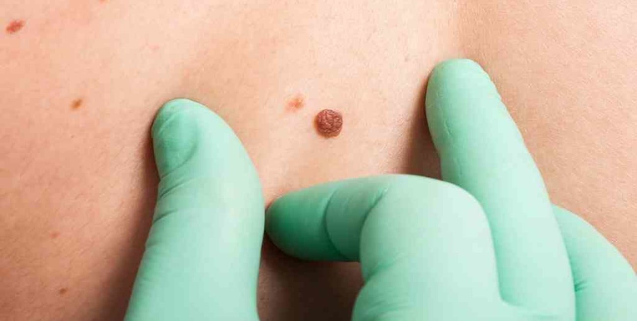 Desarrollo argentino: una vacuna terapéutica para
ciertos casos del cáncer de piel más agresivo
