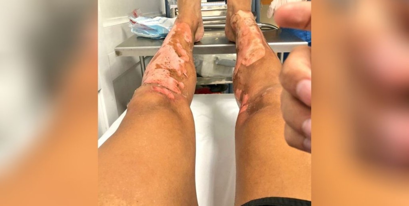 El ex Banfield Mathias Cardaccio sufrió importantes quemaduras en las piernas en accidente doméstico