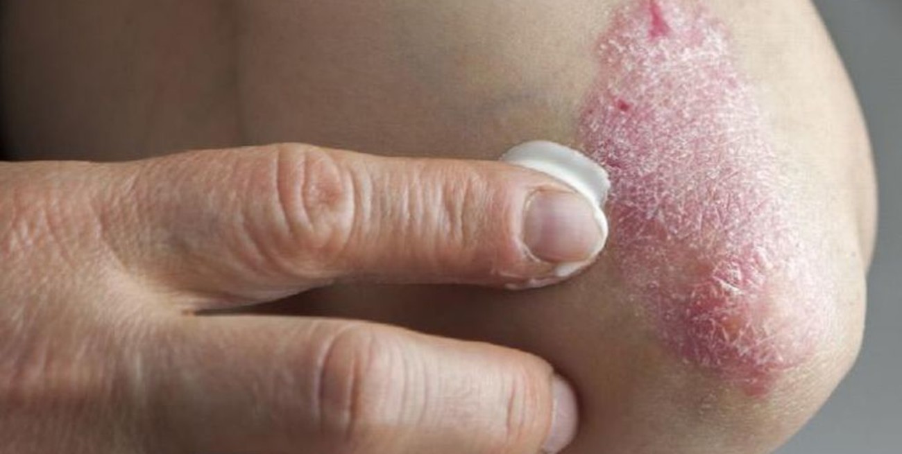 29 de octubre: Día Mundial de la Psoriasis