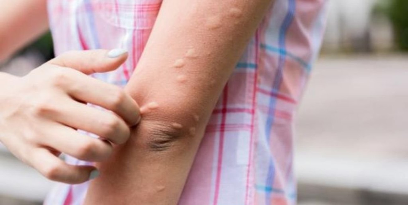 Investigadores descubren por qué los mosquitos solo atacan a algunas personas