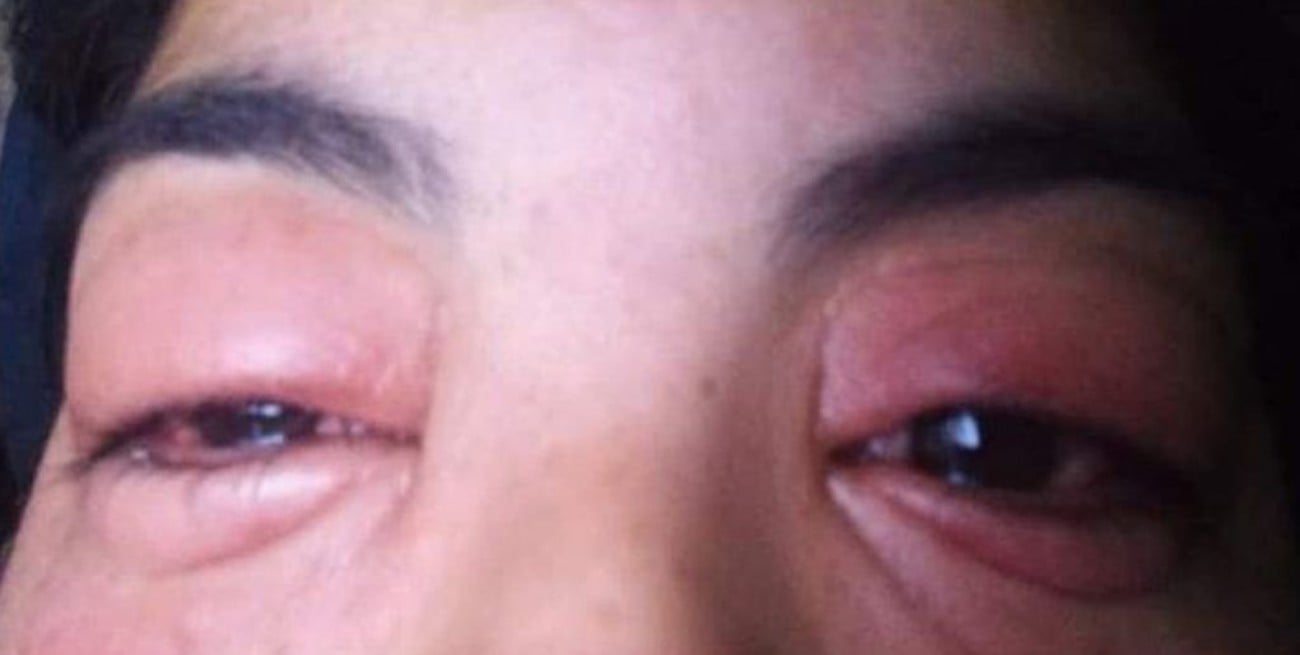 Denuncia mala praxis durante un curso de extensión de pestañas: podría perder la córnea