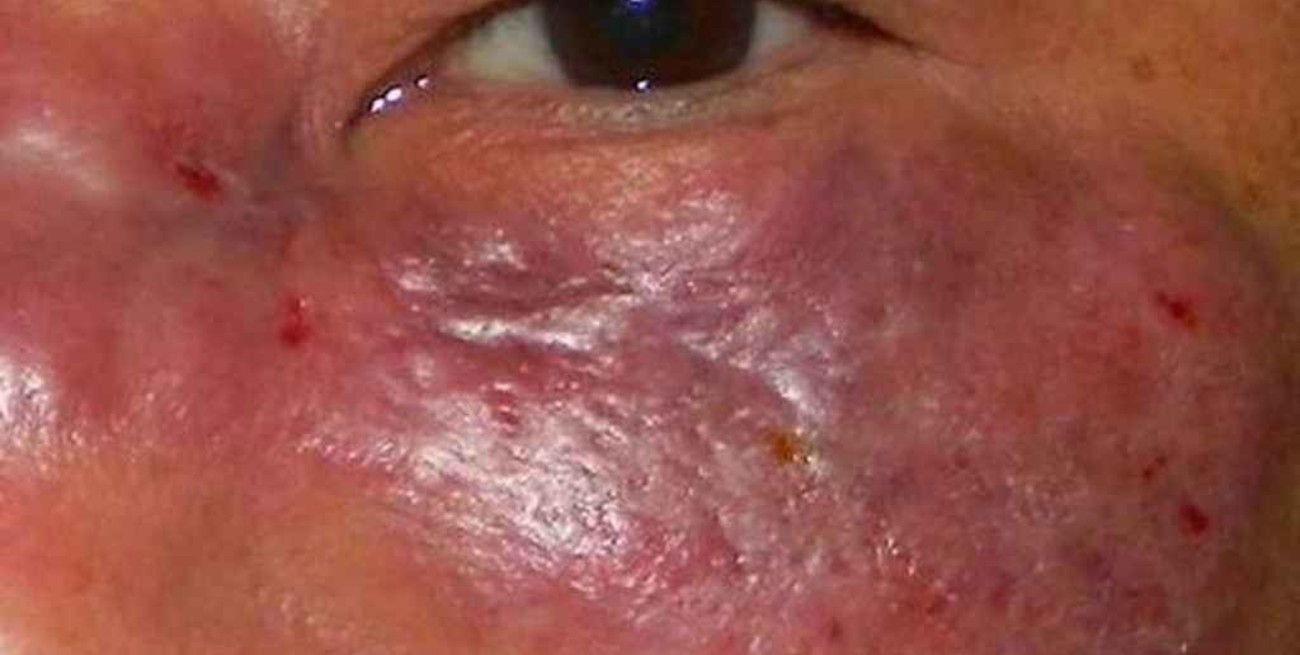 Un raro hongo letal afecta a pacientes con Covid en India