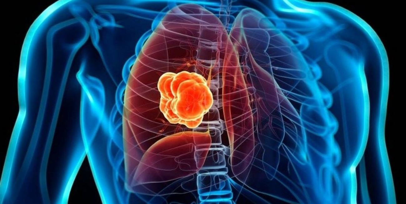 El cáncer de pulmón afecta anualmente a unos 12.000 argentinos 