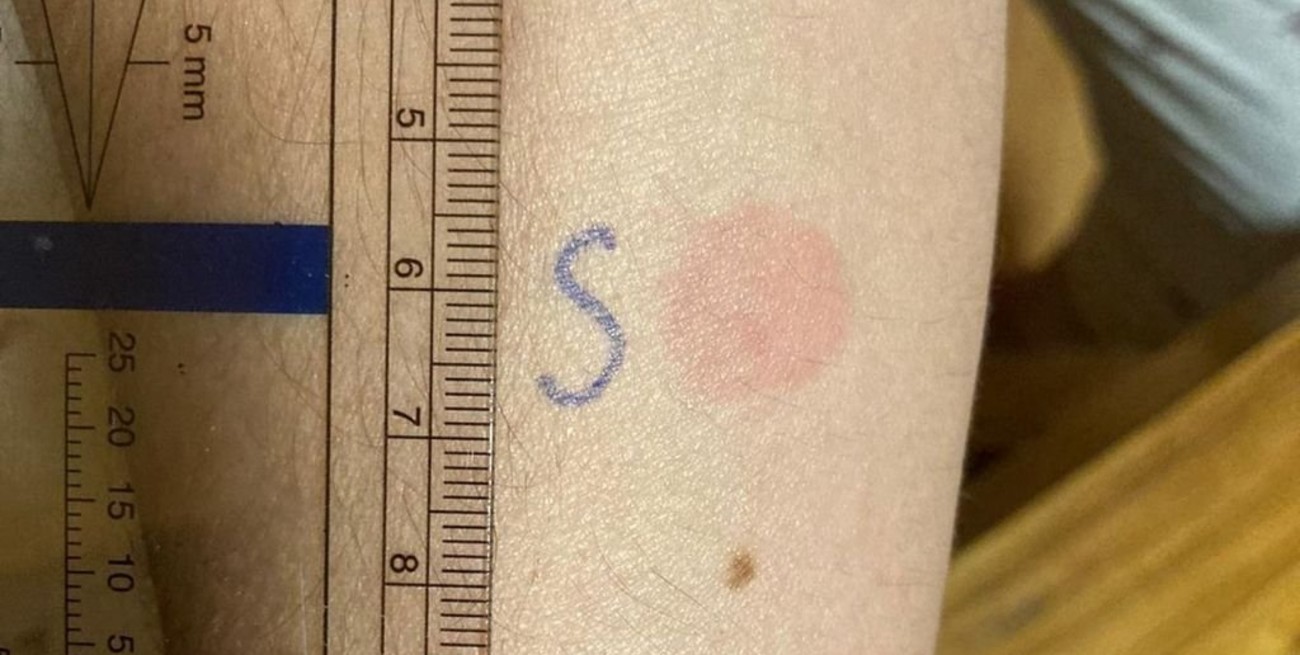 Desarrollaron un test cutáneo para saber si se necesita una dosis de refuerzo contra el coronavirus 