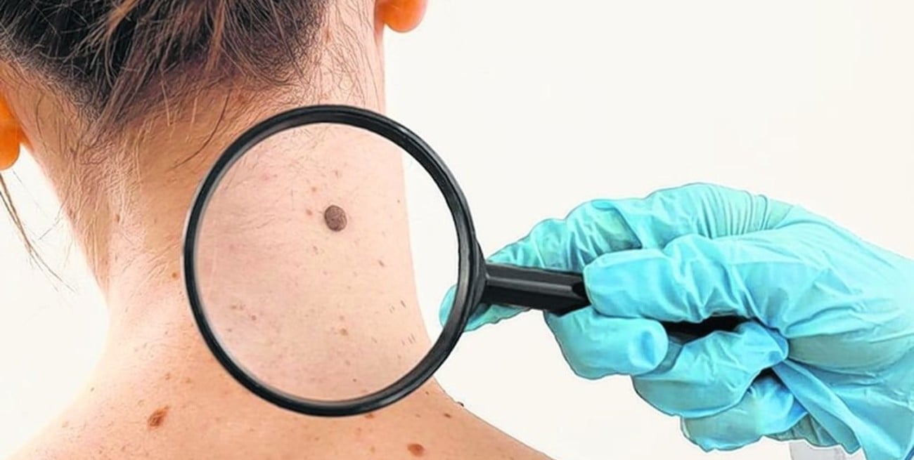 Cáncer de piel: de 432 personas chequeadas, un 18% manifestó algún hallazgo de riesgo