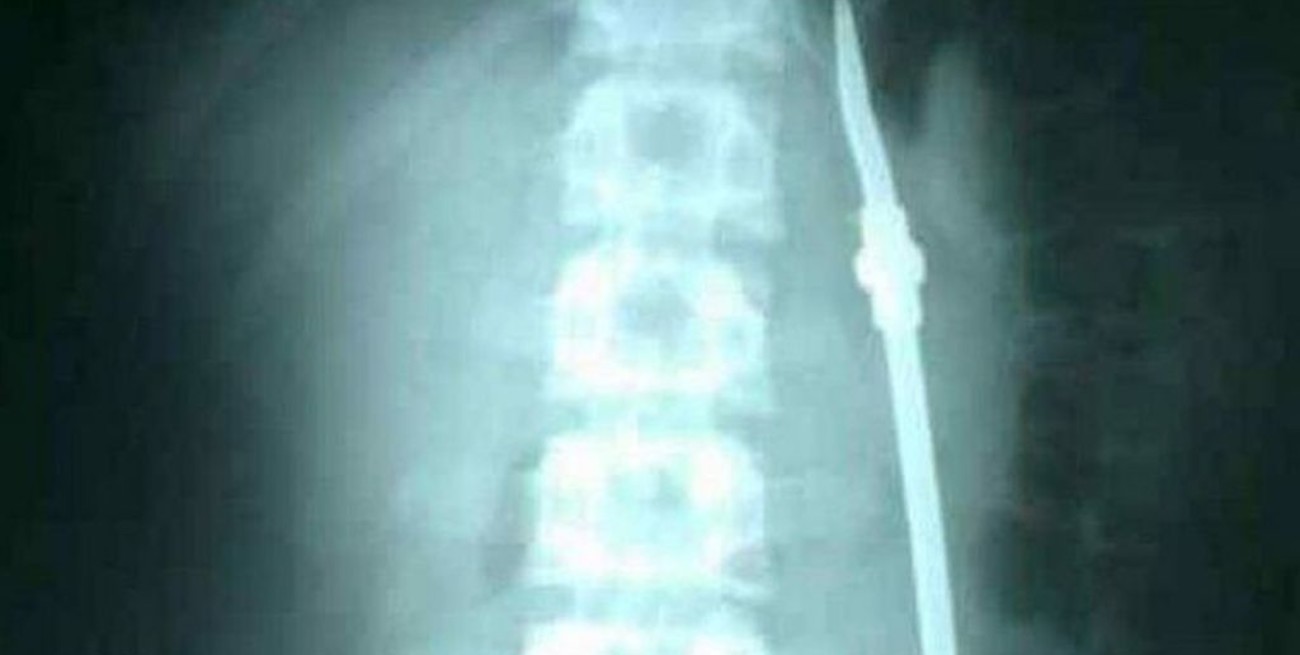 Entre Ríos: un preso se tragó una bombilla, lo operaron y aprovechó para huir