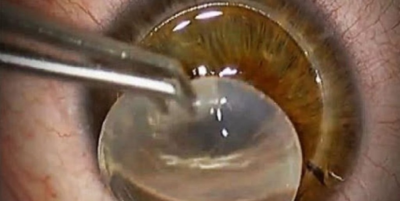 Se perdieron cinco córneas para trasplantes por las restricciones de vuelos