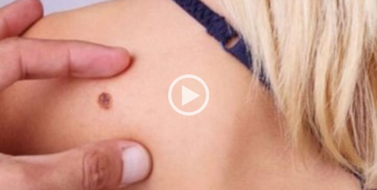 Habrá controles sin turno en la semana de la prevención del cáncer de piel