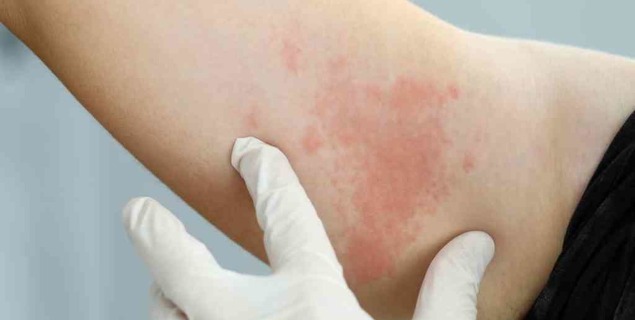 Moderna trabaja para crear vacunas contra el herpes y la varicela