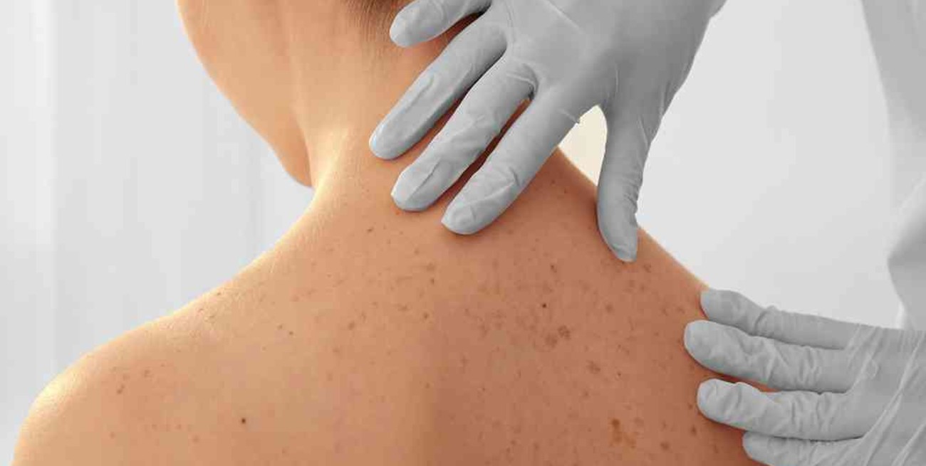 Advierten que las consultas dermatológicas "se incrementaron en forma explosiva"