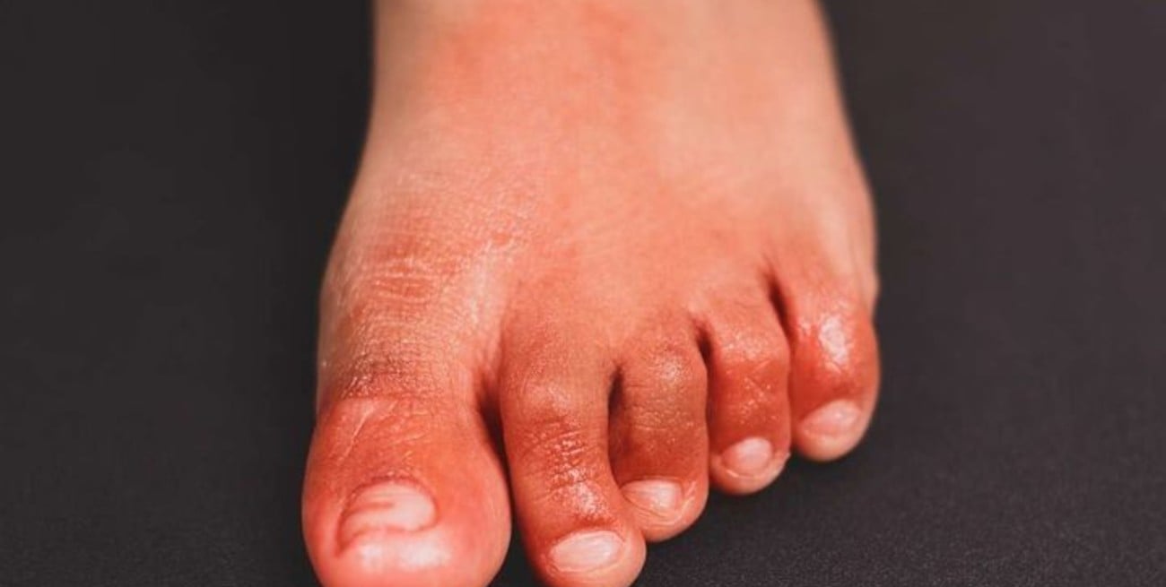 "Dedos Covid", nuevo síntoma en pacientes infectados con Ómicron