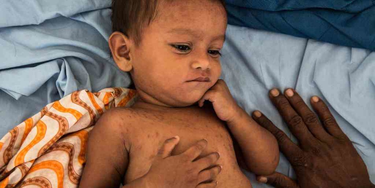 Afganistán: un brote de sarampión dejó más de 150 muertos y decenas de miles de contagiados