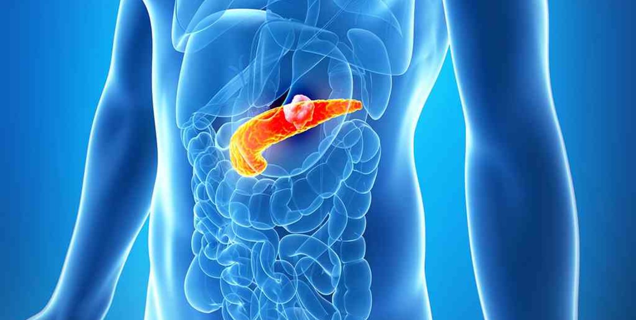 Identificaron un nuevo biomarcador para el diagnóstico precoz del cáncer de páncreas