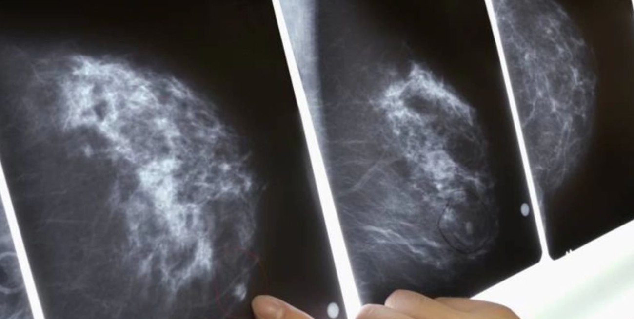 Trastuzumab deruxtecan: la nueva esperanza contra el cáncer de mama metastásico