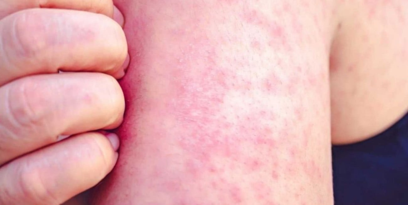 La OMS y Unicef alertan que los casos mundiales de sarampión subieron 79% desde 2020