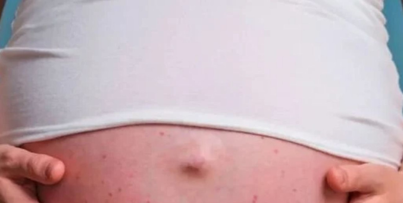 Posible caso de sarampión en una mujer embarazada de CABA