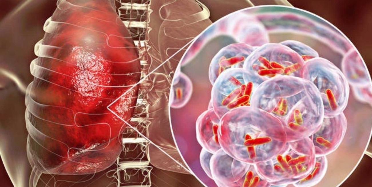 Tuberculosis: en la provincia de Santa Fe se diagnostican alrededor de 700 enfermos por año
