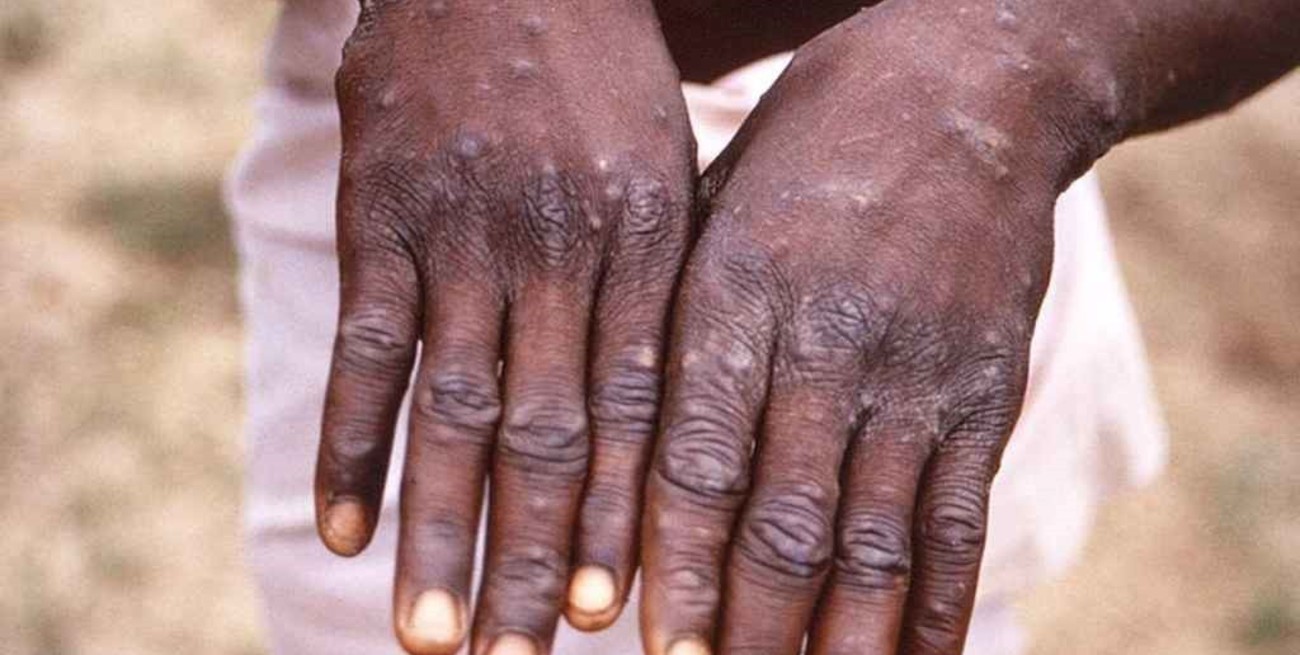 Qué es la “viruela del mono”, la rara enfermedad que fue detectada en España y Portugal