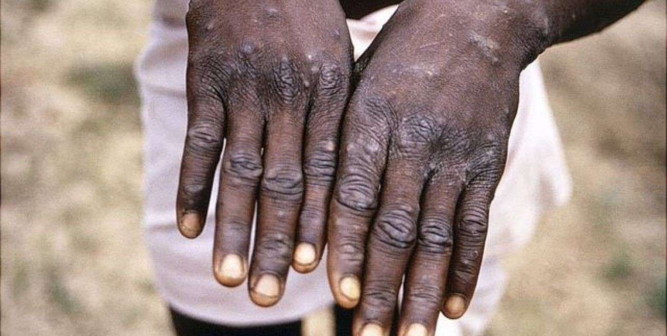 De dónde proviene la viruela de mono y cuál es su origen