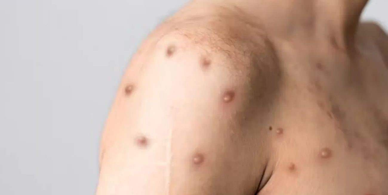 Viruela del mono: por el aumento de casos la OMS evalúa declarar la emergencia internacional