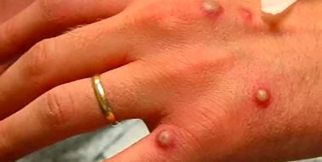 Se confirmaron 780 casos de viruela del mono en 27 países