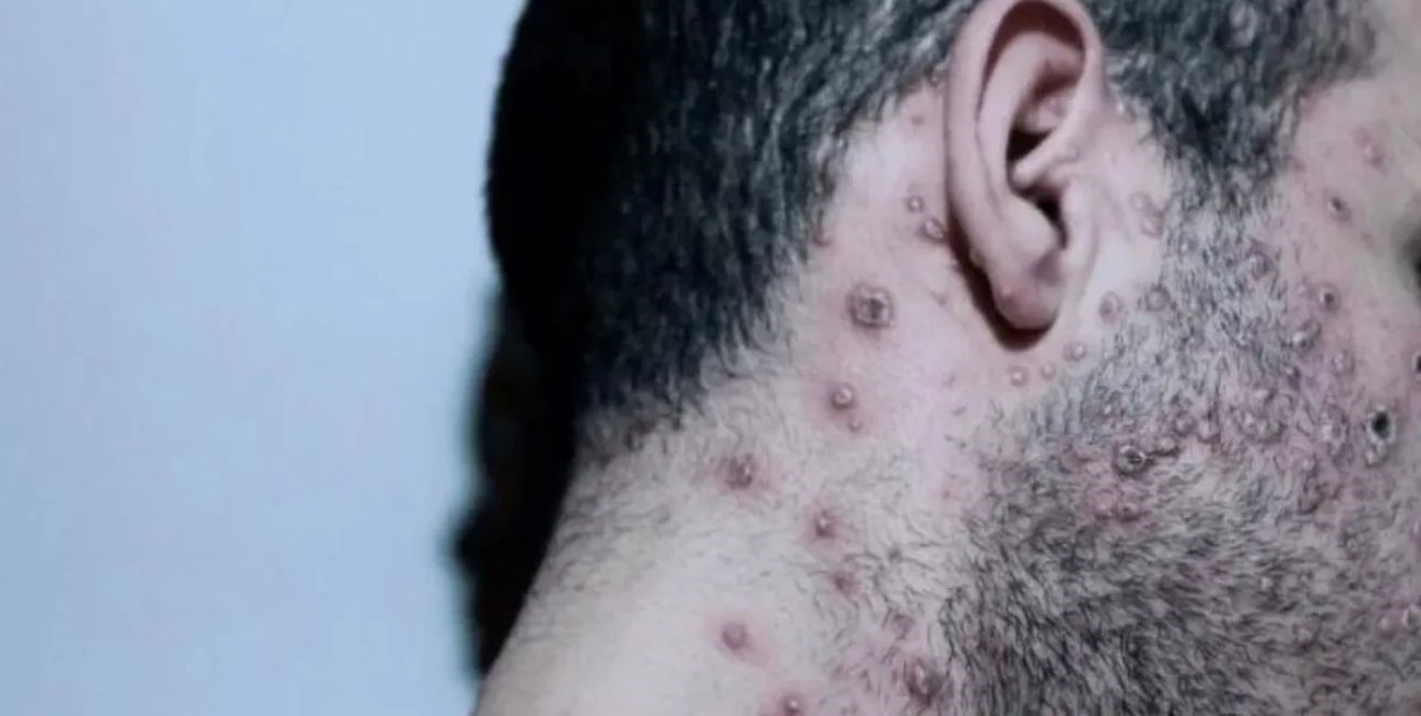 Ecuador confirmó el primer caso de la viruela del mono