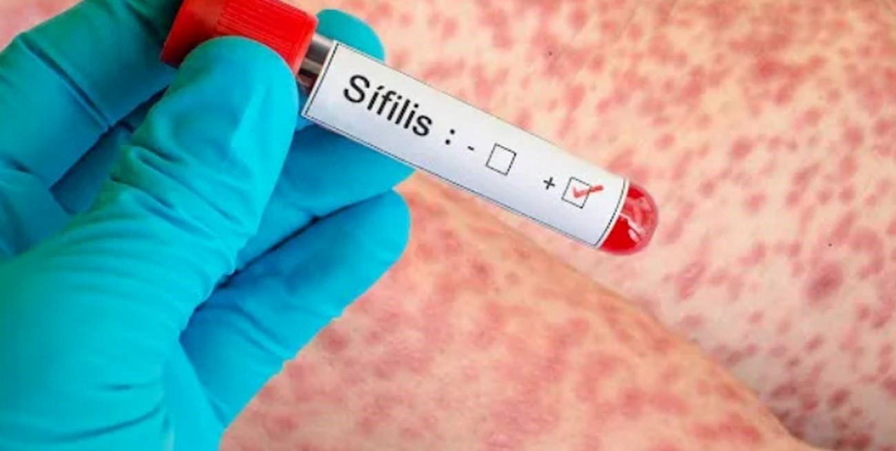 Alerta por sífilis en Argentina: aumento de reinfecciones en hombres
