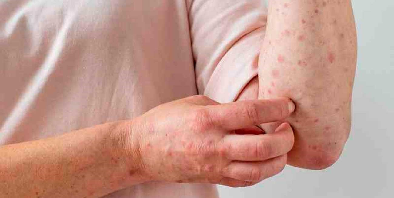 Argentina ya registró 13 casos de viruela del mono