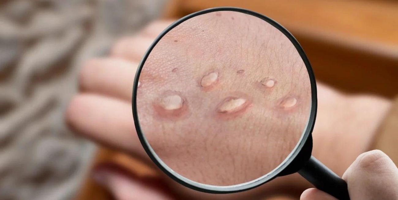 Ya se confirmaron 60 casos de viruela del mono en México