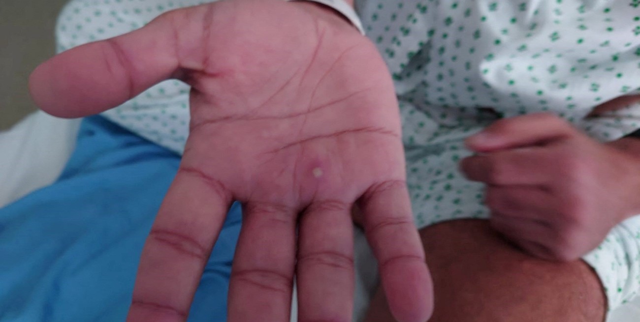 Se confirmó el primer caso de viruela del mono en la provincia de Santa Fe