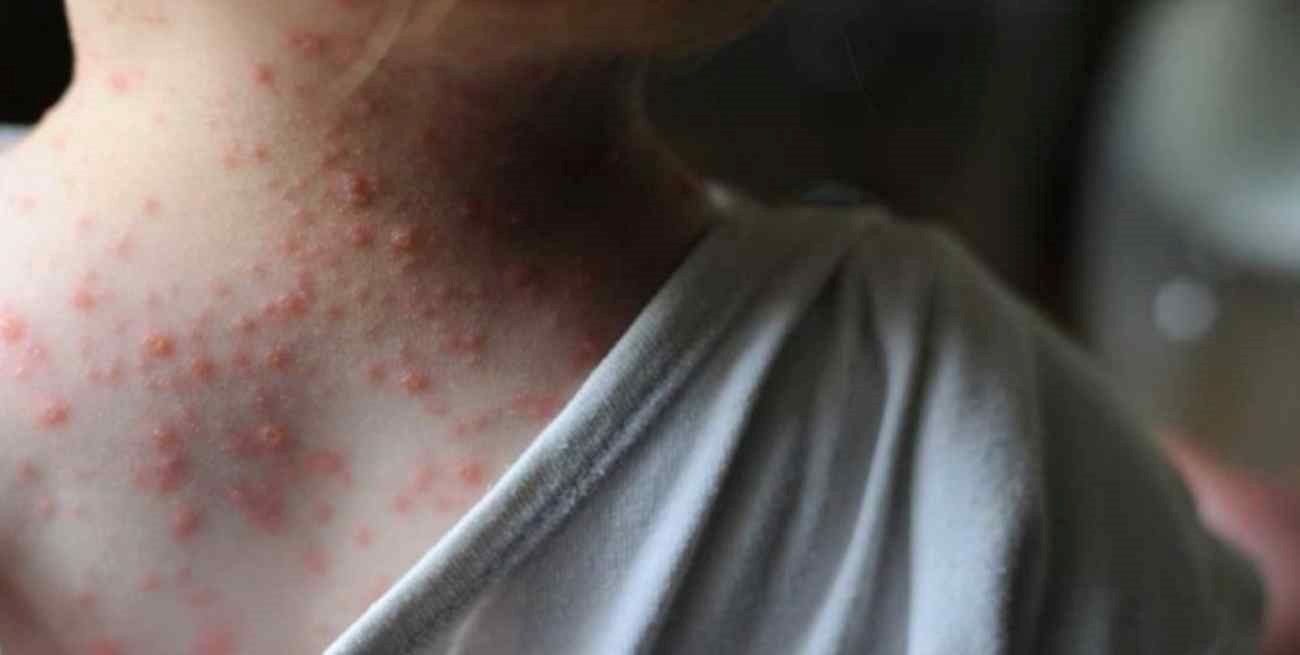 Martorano: "No hay que asustarse, pero sí estar informados sobre la viruela del mono"