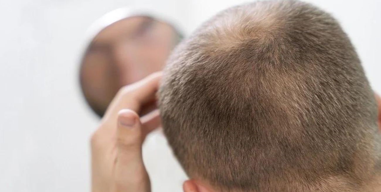 Científicos hallaron la clave para ¿la cura de la calvicie?