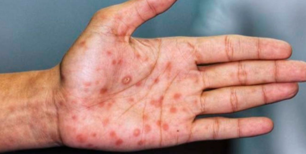 Confirman primera muerte por viruela del mono en Perú