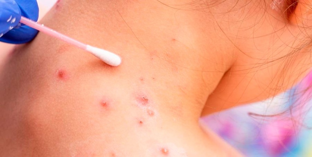 Viruela del mono vs. varicela: similitudes, diferencias y cuidados