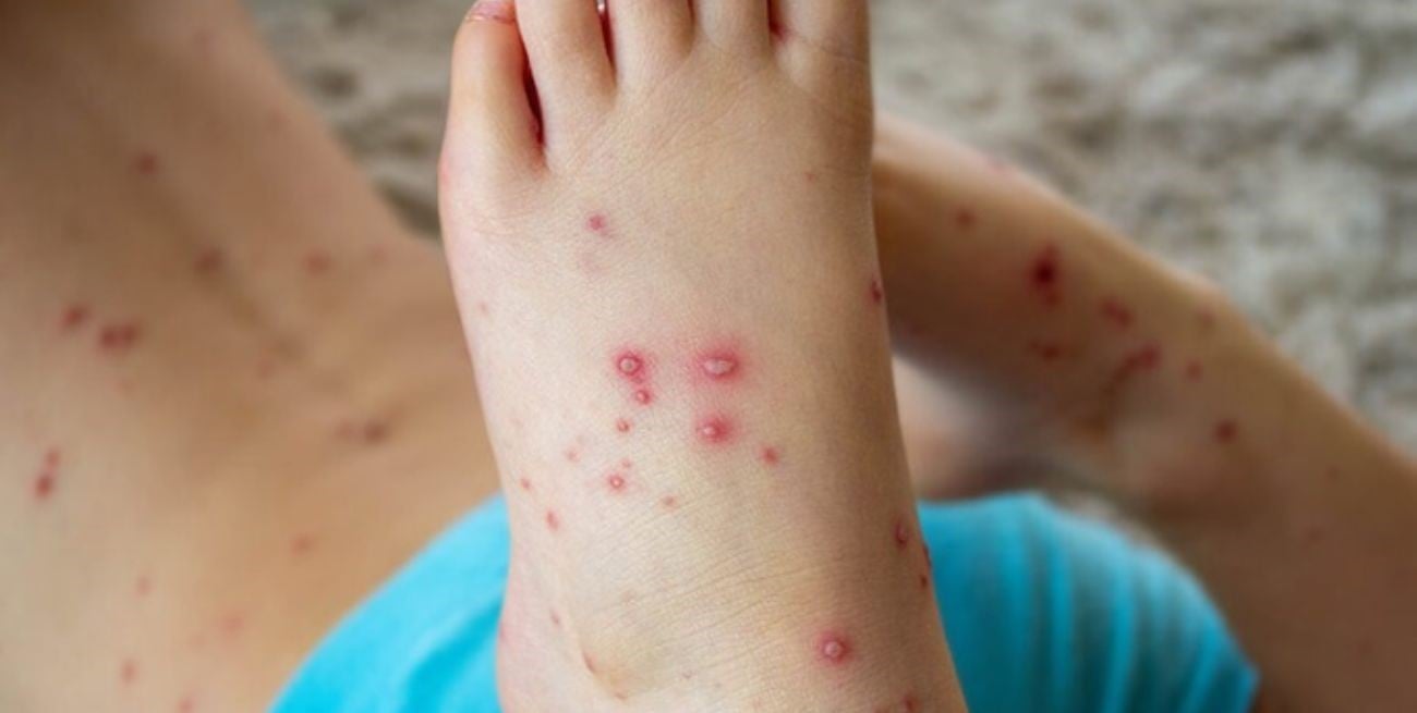 Gripe del tomate: nueva enfermedad viral que aparecido en la India