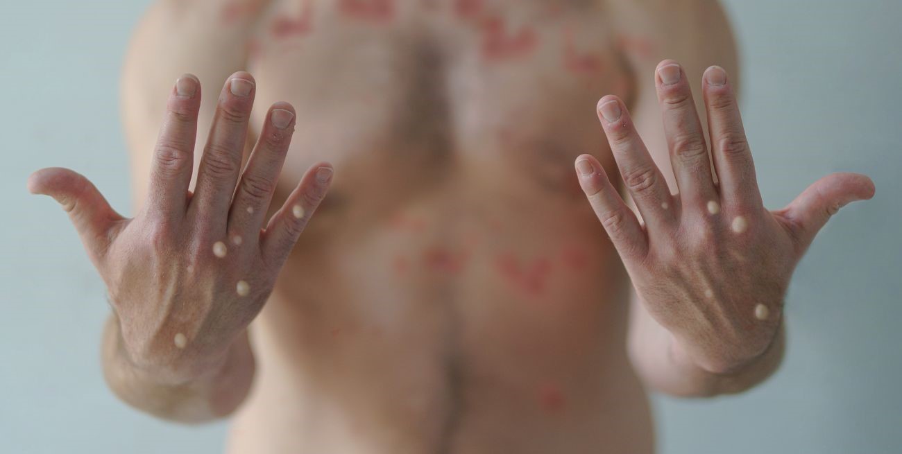 Ya son 265 los casos de viruela de mono en Argentina