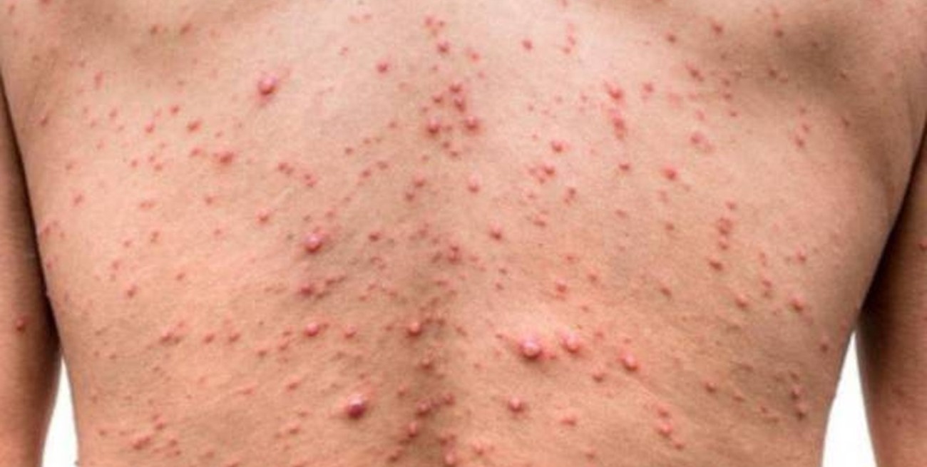 Advierten que la viruela de mono o mpox se trasmite por vía sexual