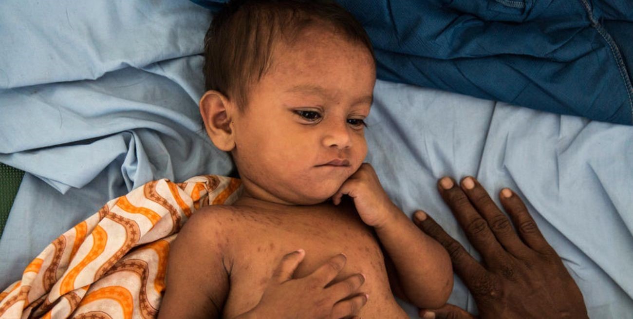 Se reportan 700 niños muertos por brote de sarampión en Zimbabue