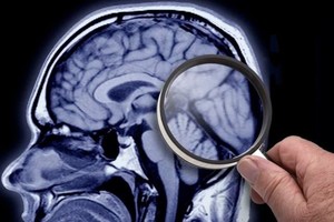 "Según lo publicado por las investigaciones, el Lecanemab arrojó un promedio de retraso de síntomas del 27,5 % durante el año y medio que fue aplicado. Del Donanemab refieren un 35 % y un porcentaje aún mayor si se aplica en paciente en etapa de deterioro cognitivo leve", dice el especialista.