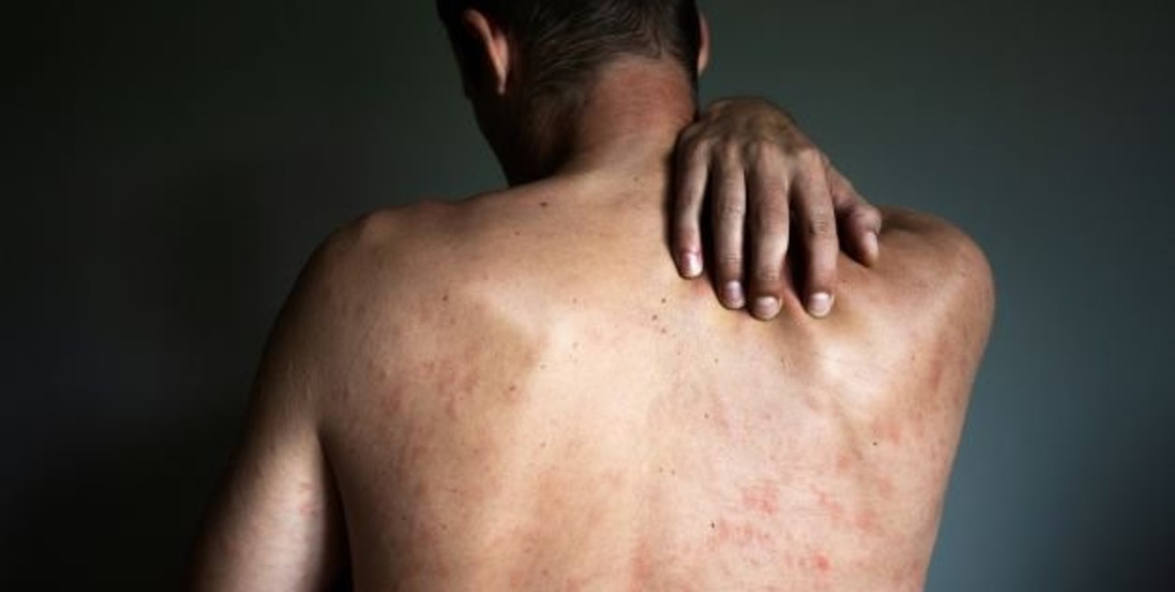 Se confirmó el tercer caso de viruela del mono en la provincia de Santa Fe