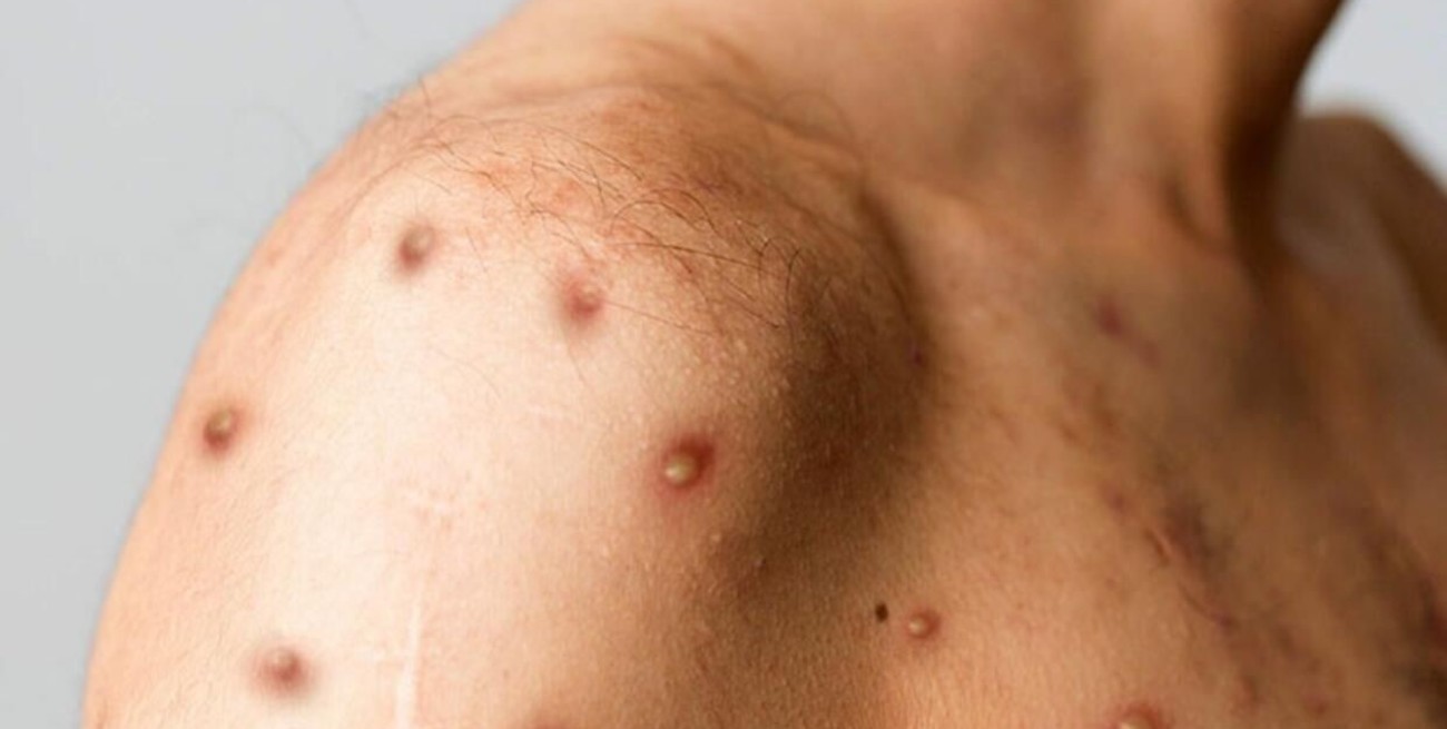 Se refuerza la vigilancia epidemiológica ante el aumento de casos de viruela del mono en el país