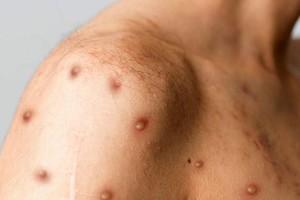 Entre las semanas epidemiológicas 1 y 34 de este año, se confirmaron 22 casos.