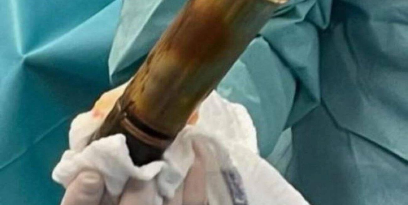 Un anciano provocó la evacuación de un hospital francés: llegó a urgencias con una bomba en el recto